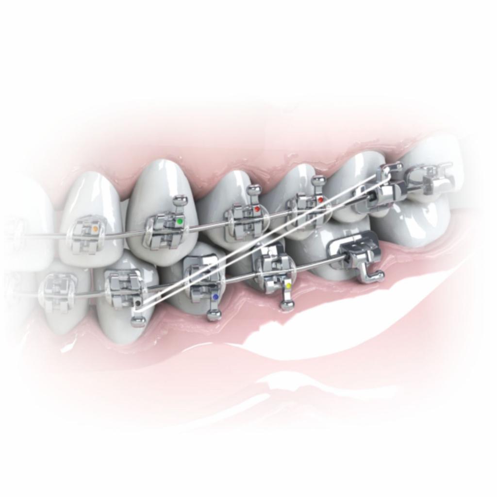 ELASTICO INTRAORAL_5