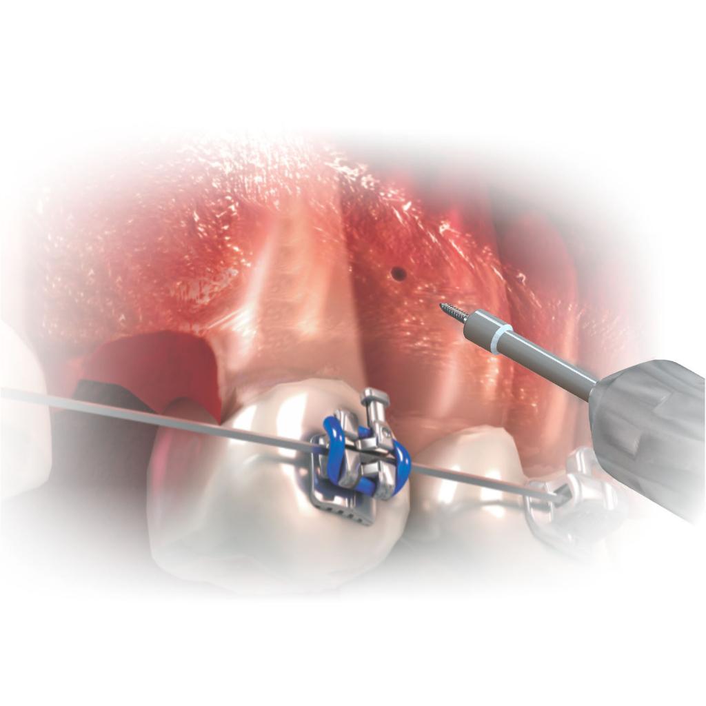 EXTENSIÓN LLAVE HEXAGONAL TALLO MEDIO MORELLI_2
