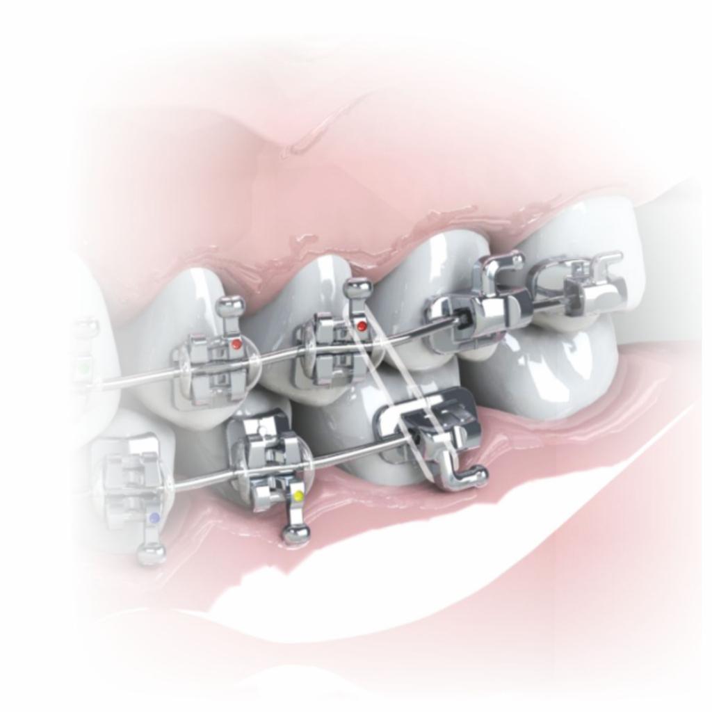 ELASTICO INTRAORAL_4