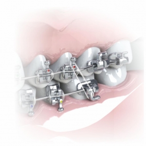 ELASTICO INTRAORAL_4