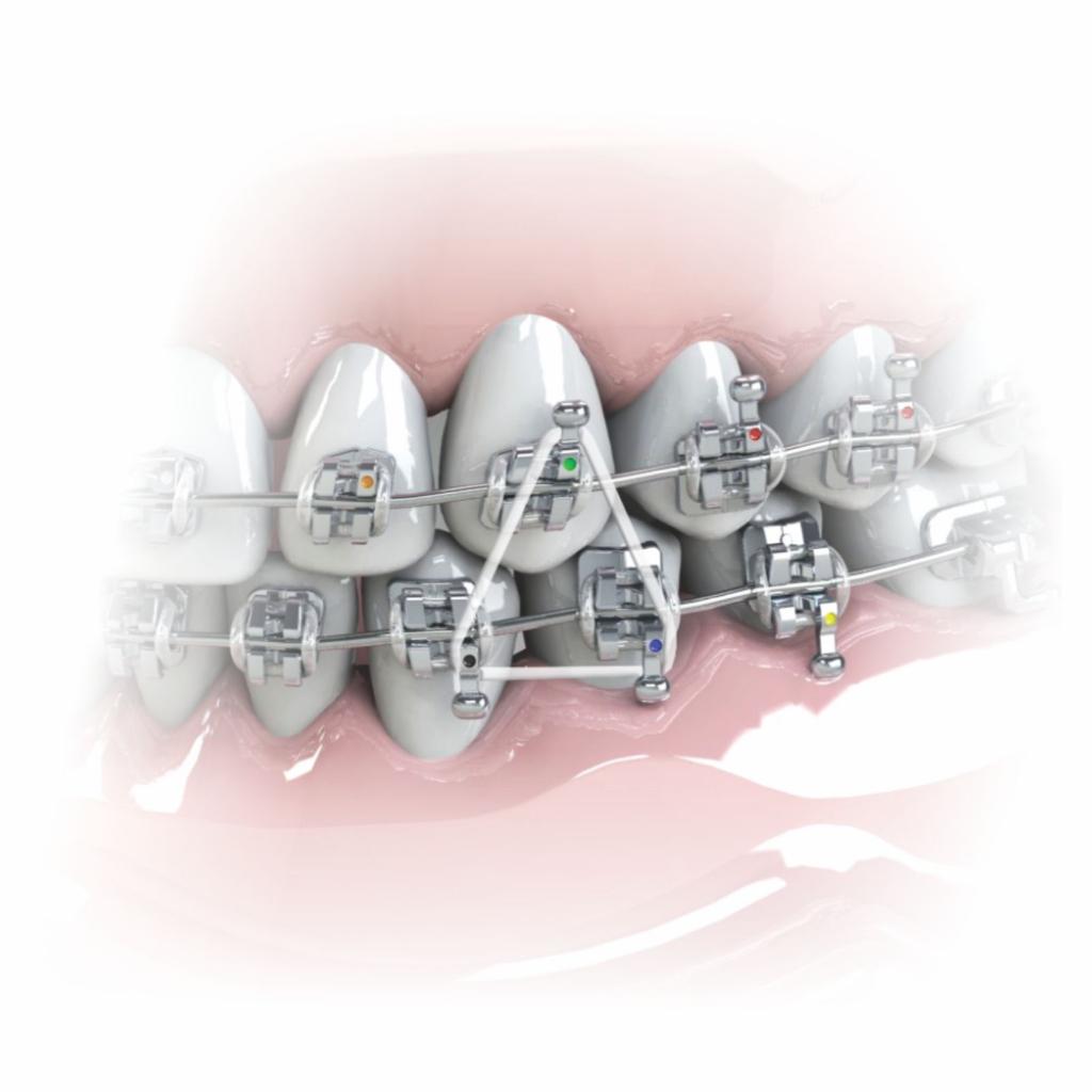 ELASTICO INTRAORAL_3