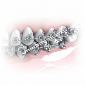 ELASTICO INTRAORAL_5